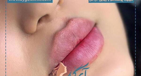 عکس مدل لب عروسکی