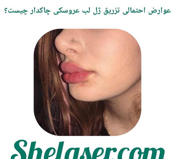 عکس مدل لب عروسکی