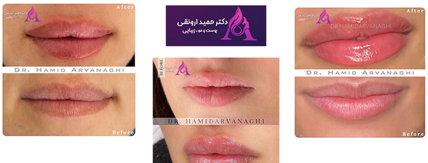 عکس مدل لب عروسکی