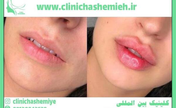عکس مدل لب عروسکی