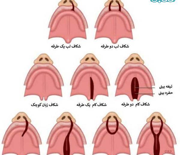 عکس جنین لب شکری در سونوگرافی