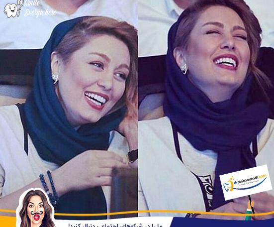عکس پروتز لب سحر قریشی