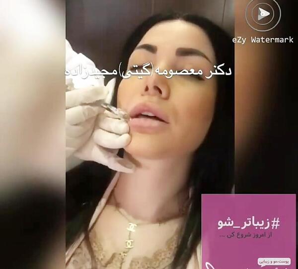 عکس پروتز لب سحر قریشی