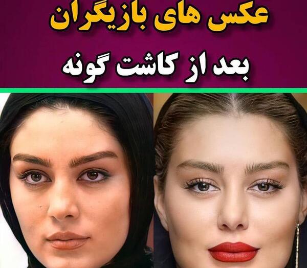 عکس پروتز لب سحر قریشی