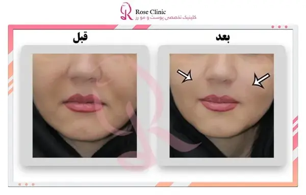 عکس تزریق ژل لب دو سی سی