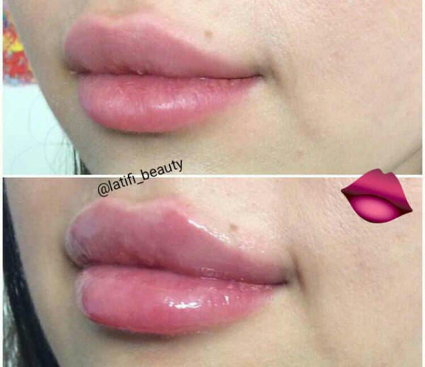 عکس تزریق ژل لب دو سی سی
