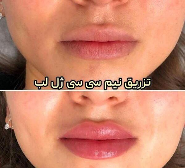 عکس تزریق ژل لب دو سی سی