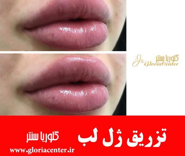 عکس تزریق ژل لب دو سی سی