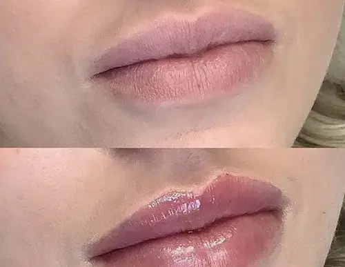 عکس تزریق ژل لب دو سی سی