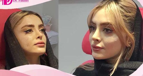 عکس تزریق ژل لب دو سی سی