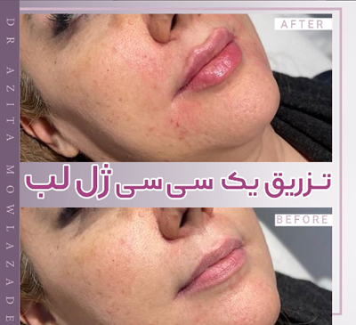 عکس تزریق ژل لب دو سی سی