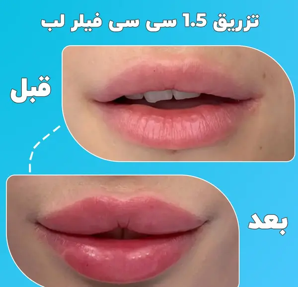 عکس تزریق ژل لب دو سی سی
