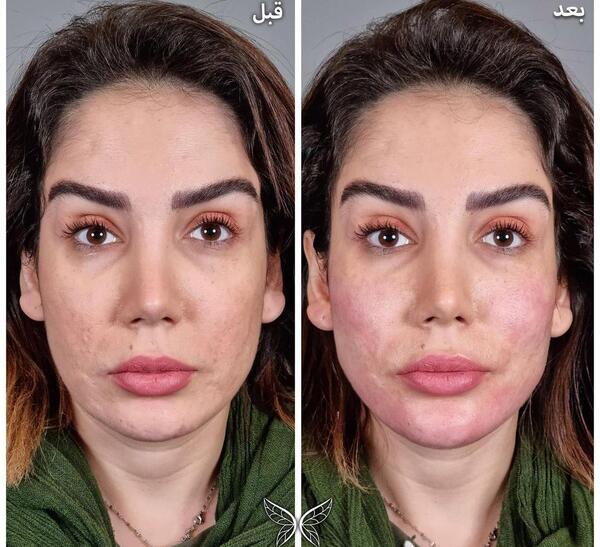 عکس ورم لب بعد از تزریق ژل