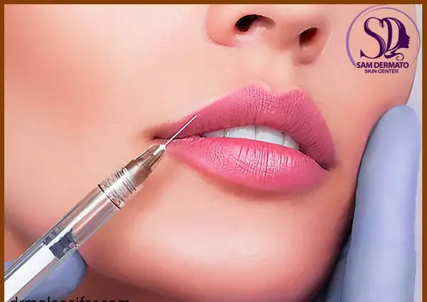 عکس ورم لب بعد از تزریق ژل