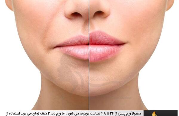 عکس ورم لب بعد از تزریق ژل