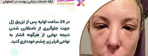 عکس ورم لب بعد از تزریق ژل