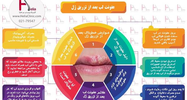عکس ورم لب بعد از تزریق ژل