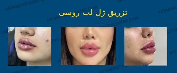 عکس ورم لب بعد از تزریق ژل