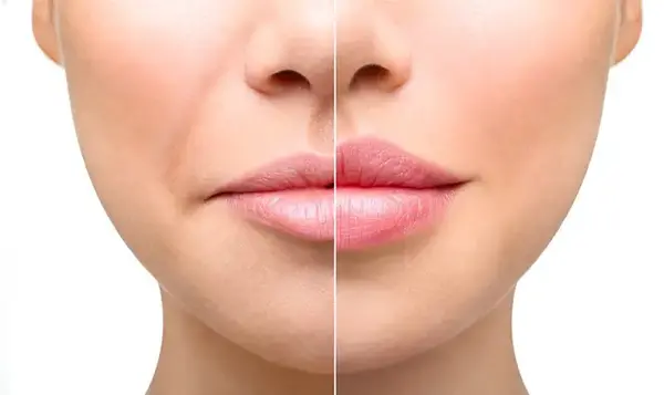 عکس ورم لب بعد از تزریق ژل