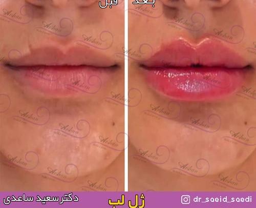عکس ورم لب بعد از تزریق ژل