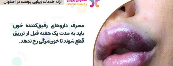 عکس ورم لب بعد از تزریق ژل