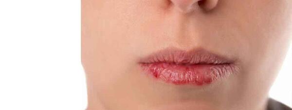 عکس عفونت لب بعد از تزریق ژل