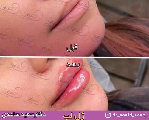 عکس عفونت لب بعد از تزریق ژل