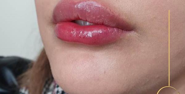 عکس عفونت لب بعد از تزریق ژل