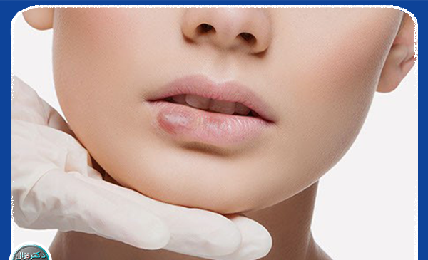 عکس عفونت لب بعد از تزریق ژل