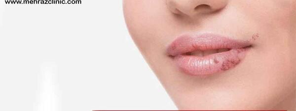 عکس عفونت لب بعد از تزریق ژل