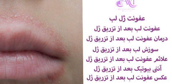 عکس عفونت لب بعد از تزریق ژل