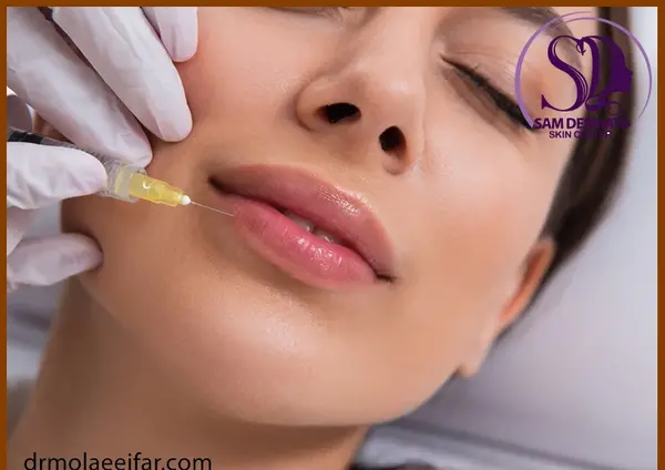 عکس عفونت لب بعد از تزریق ژل