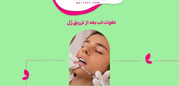 عکس عفونت لب بعد از تزریق ژل