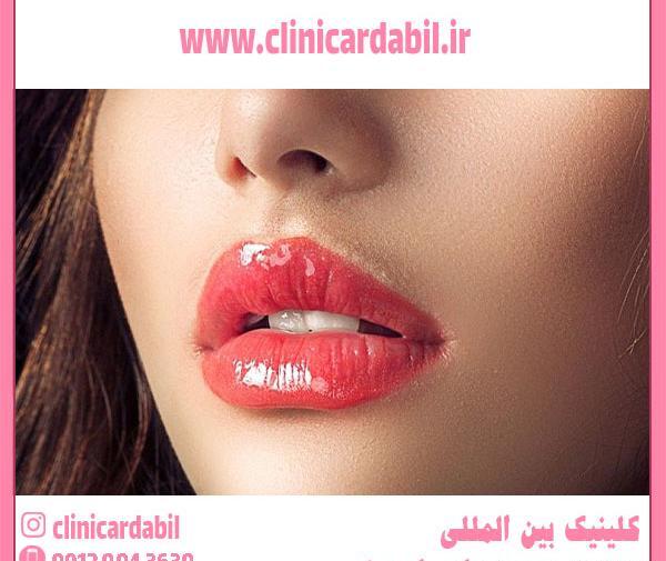 عکس عفونت لب بعد از تزریق ژل