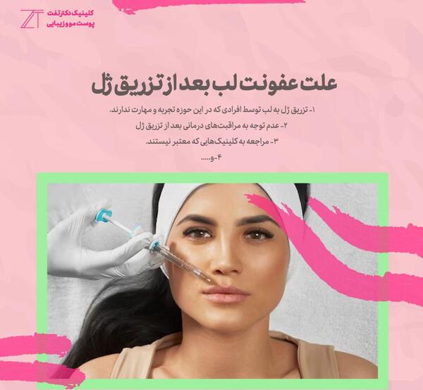 عکس عفونت لب بعد از تزریق ژل