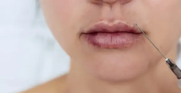 عکس عفونت لب بعد از تزریق ژل