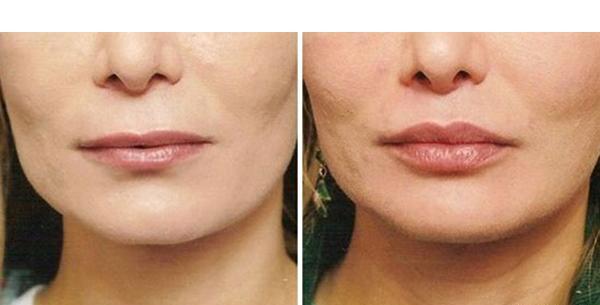 عکس لب ژل زده نیم سی سی