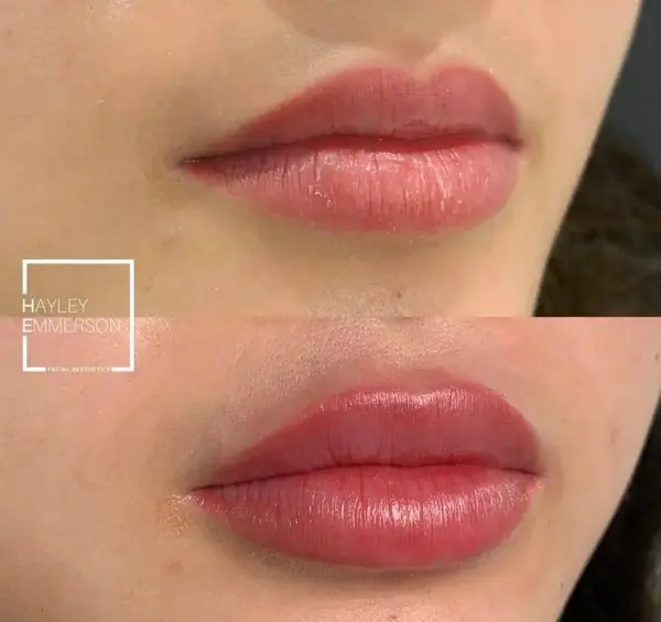 عکس لب ژل زده نیم سی سی