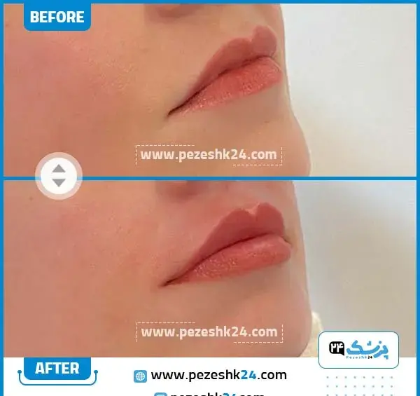 عکس لب ژل زده نیم سی سی