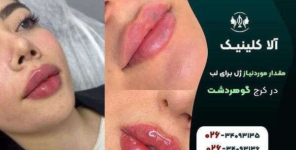 عکس لب ژل زده نیم سی سی