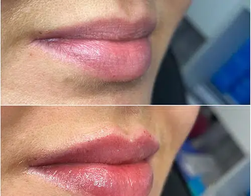 عکس لب ژل زده نیم سی سی
