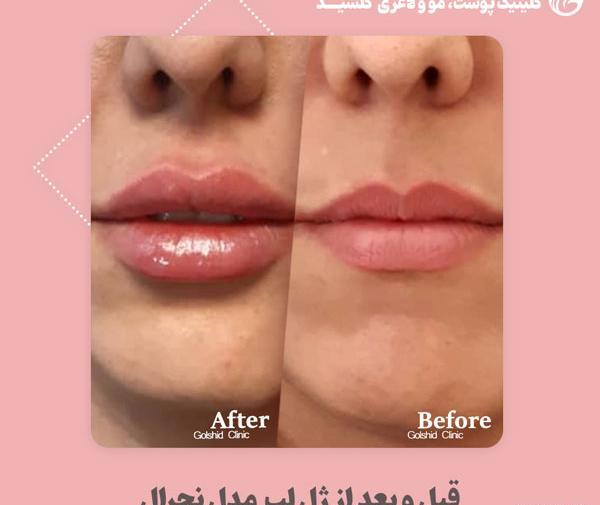 عکس لب ژل زده نیم سی سی