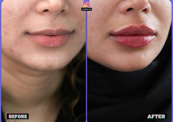 عکس لب ژل زده نیم سی سی
