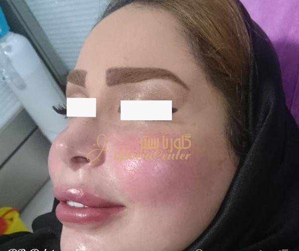 عکس لب ژل زده نیم سی سی