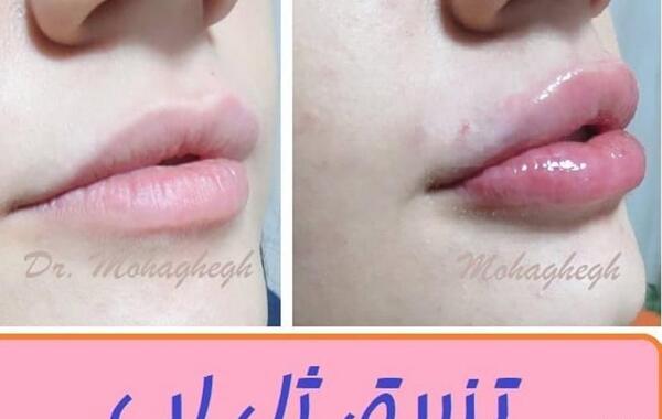 عکس لب ژل زده نیم سی سی