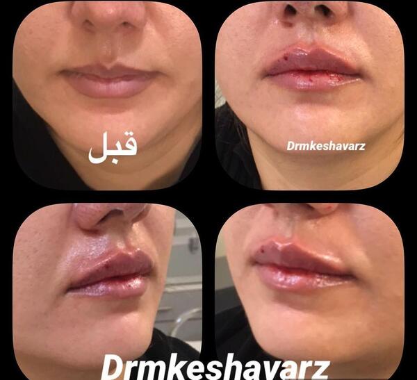 عکس لب ژل زده نیم سی سی