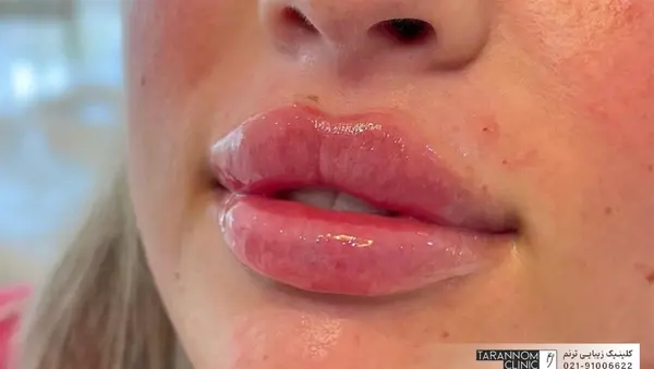 عکس لب ژل روسی