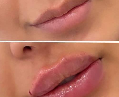 عکس لب ژل روسی