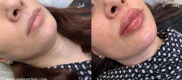 عکس لب ژل روسی