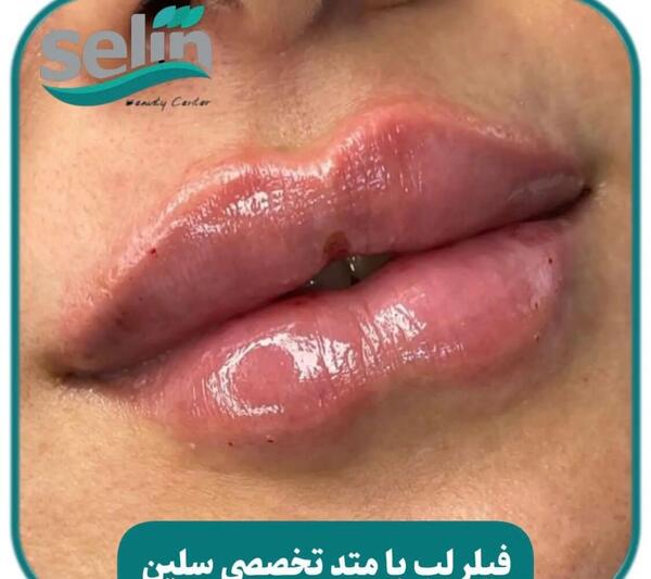عکس لب ژل زده شده